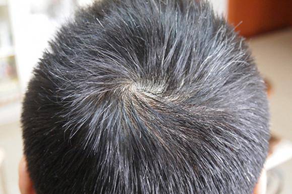 头发变白形成原因 看哪些你已中招