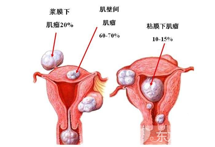 治疗子宫肌瘤的偏方 这些居然是子宫肌瘤的早起症状