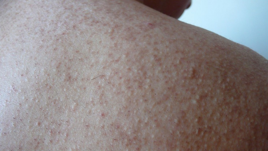 毛周角化是什么 揭你所不知的 鸡皮肤 治疗