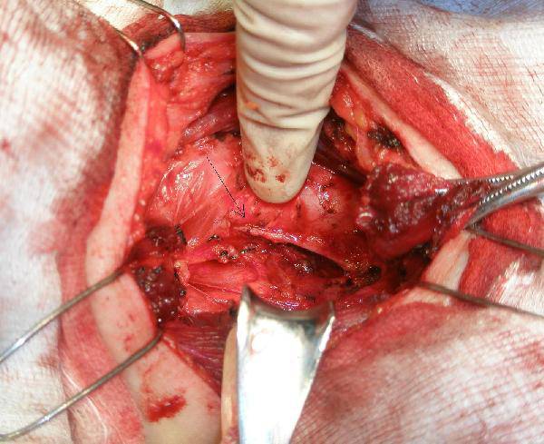 甲状腺癌术后饮食禁忌 解读甲状腺癌各类症状