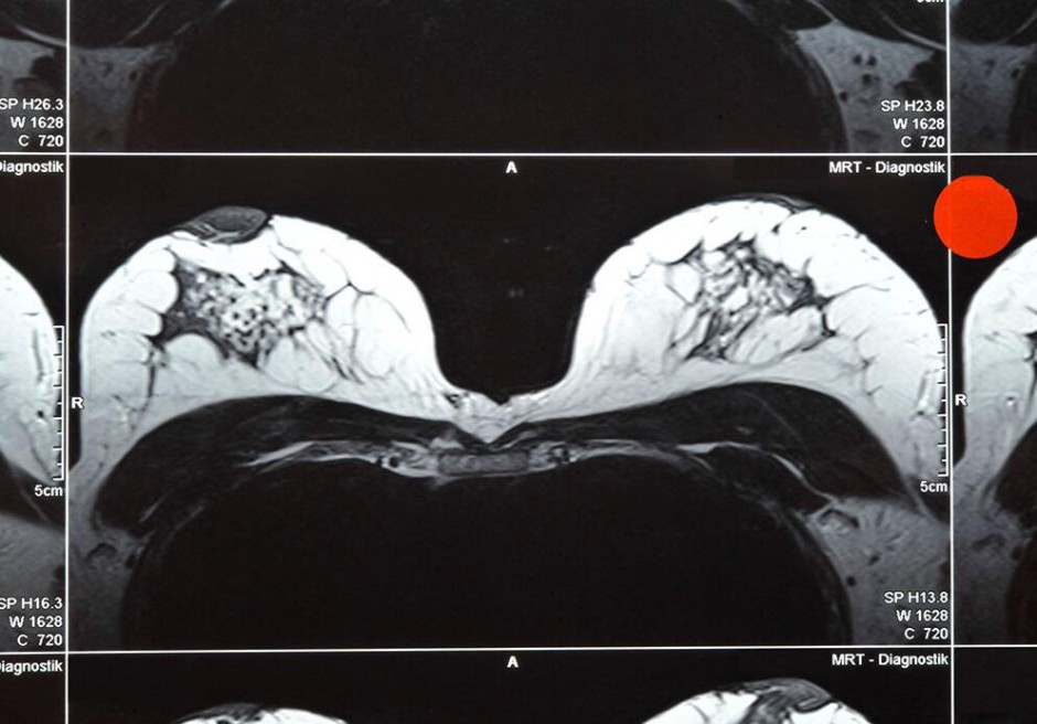 磁共振检查有哪些优势  揭乳腺磁共振的作用
