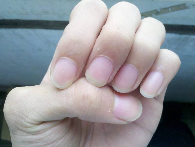 指甲上有竖纹是怎么回事 5个妙招教你如何调理