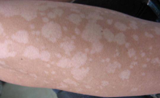 汗斑如何预防 荐5个有效治疗小妙招