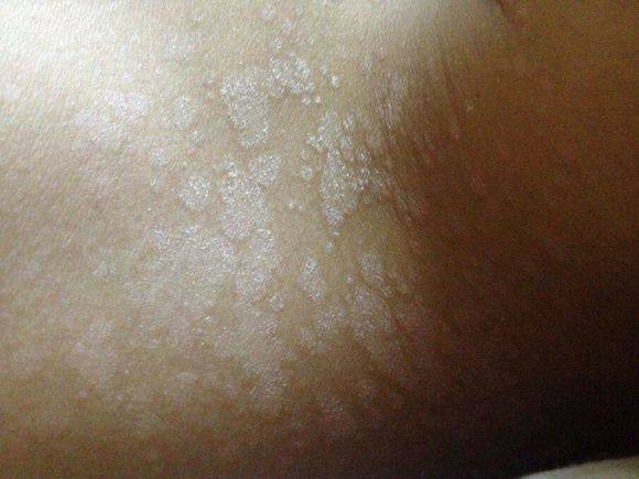 汗斑如何预防 荐5个有效治疗小妙招