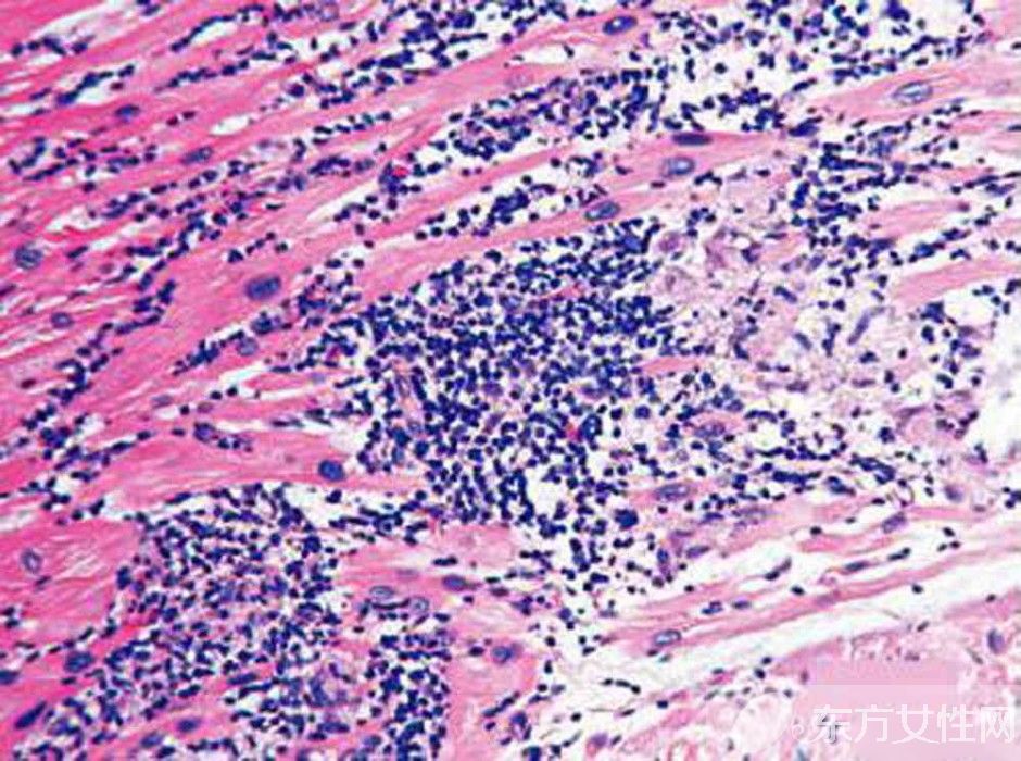 心肌炎是怎么引起的 稍不注意有可能猝死你知道吗