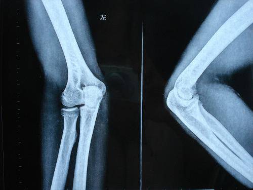 骨折愈合时间需要多久 愈合康复训练