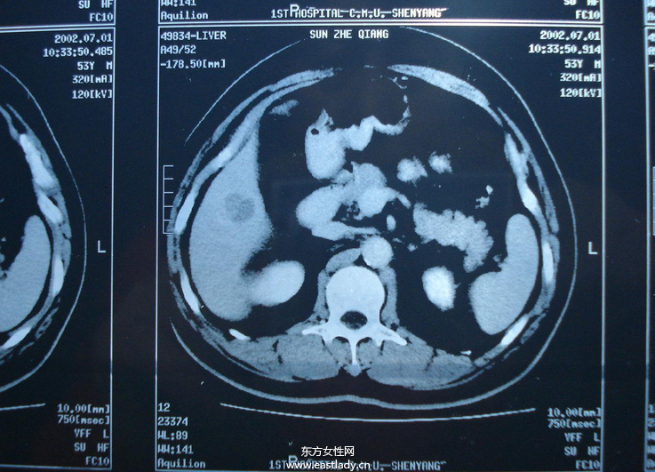 中晚期肝癌介入治疗的方法有哪些