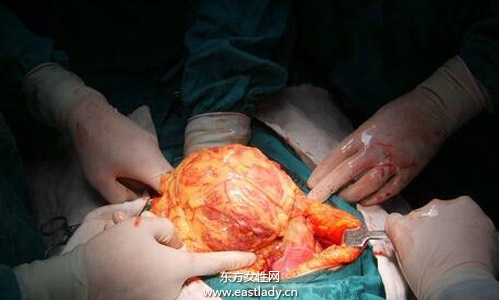 肝囊肿是怎么形成的 应该注意哪方面的饮食习惯