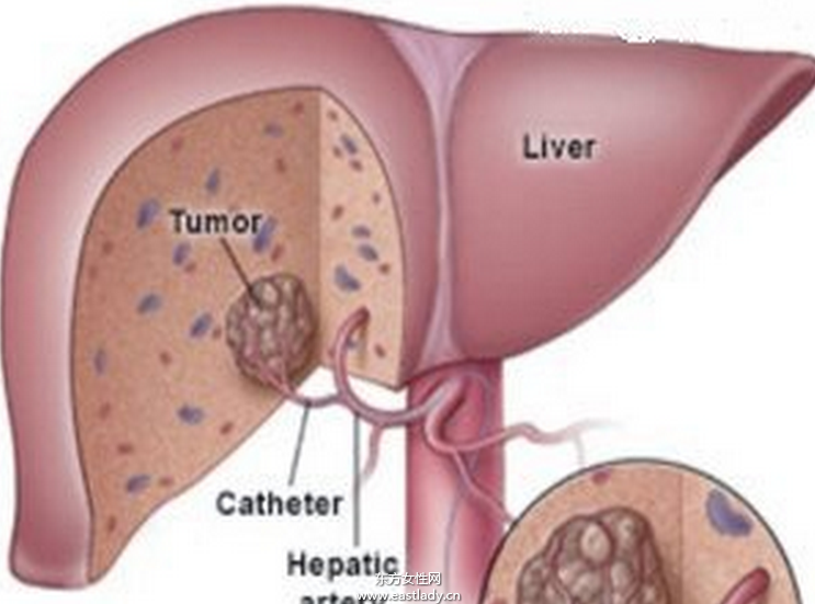 中晚期肝癌介入治疗的方法有哪些