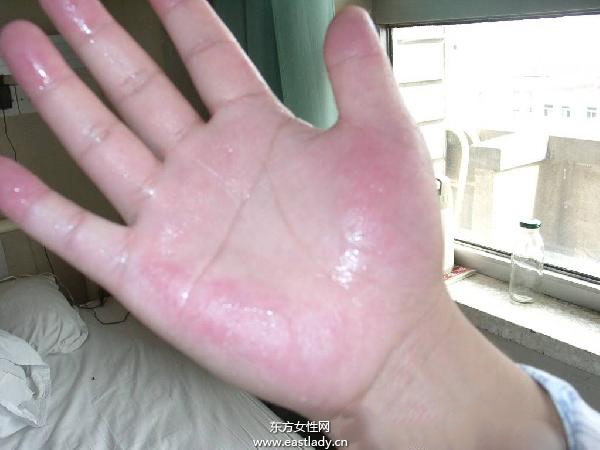 手脚出汗是怎么回事 应该如何治疗呢