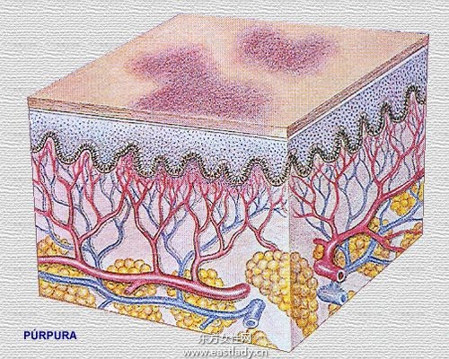 毛细血管破裂是怎么回事 揭秘毛细血管破裂的症状