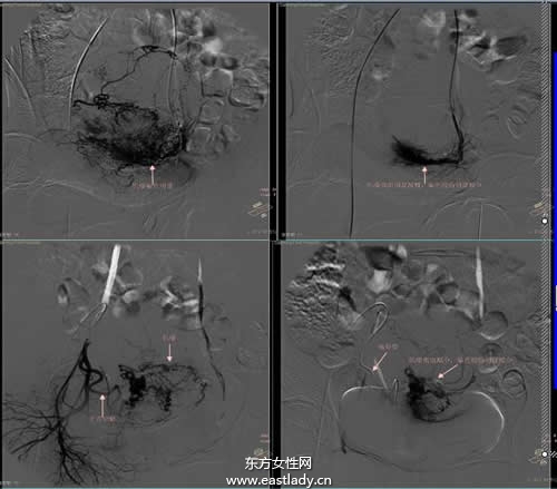 中晚期肝癌介入治疗的方法有哪些