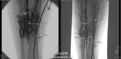 中晚期肝癌介入治疗的方法有哪些
