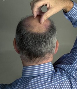 脱发怎么办 预防男人脱发吃什么好