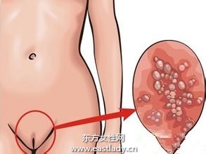 女性尖锐湿疣早期症状有哪些