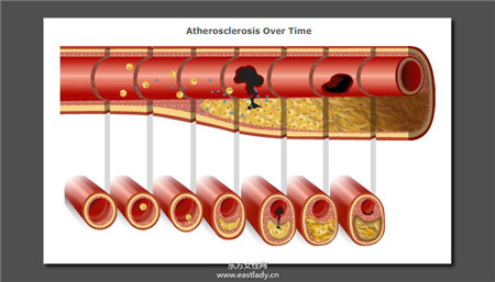 血管硬化怎么办 6 种方法能够帮血管洗澡