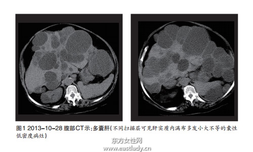 肝囊肿是怎么形成的 应该注意哪方面的饮食习惯