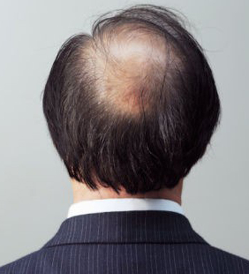男人为什么会脱发 男人头发会变少的8个原因