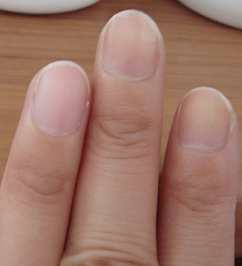 健康自测有妙招 皮肤和指甲告诉你身体状况