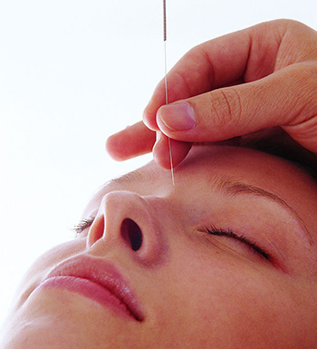 中医针灸的功效及注意事项有哪些