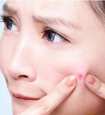 长痘痘不能吃什么 杜绝这些食物远离痘痘