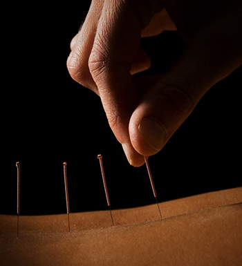 中医针灸的功效及注意事项有哪些