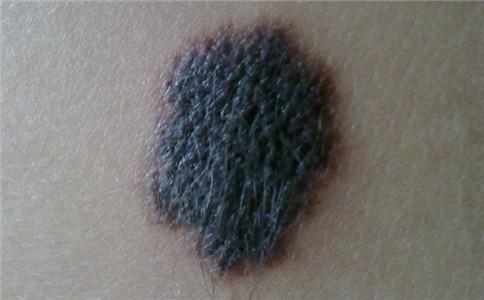 黑色素瘤和痣傻傻分不清 黑色素瘤和痣的区别