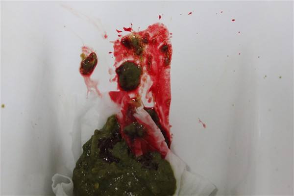 大便出血是什么原因以及大便出血怎么办