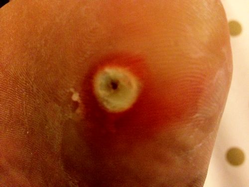 脚上长鸡眼怎么办 治疗鸡眼的祖传偏方