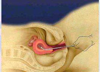 最后的补救措施 人流后多久可以出门