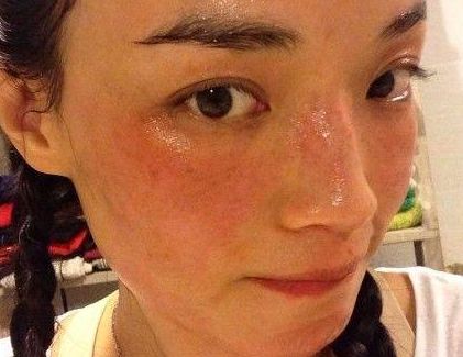 脸部过敏发红怎么办以及它的注意事项是什么