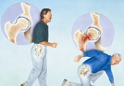 骨质疏松的需要补充的营养元素介绍