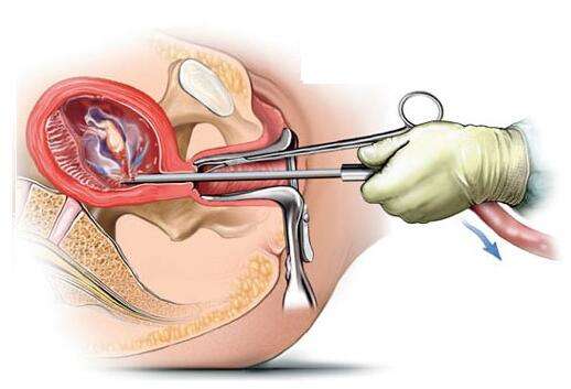 四大人工流产方式你知道吗