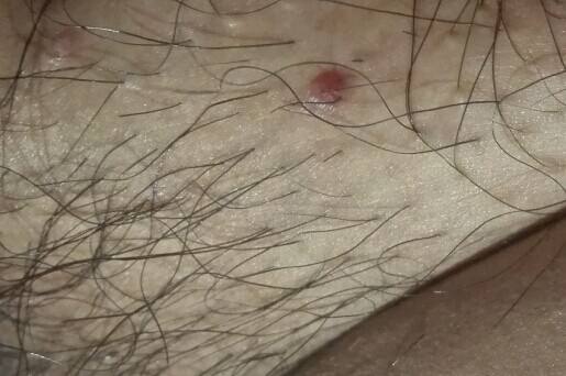 疱疹是怎么引起的以及治疗方法是什么