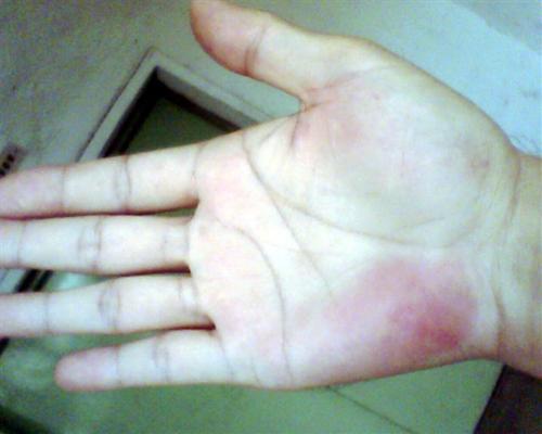 手脱皮怎么办，三招立马解决