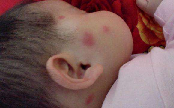 挠挠挠皮肤瘙痒起红疙瘩怎么办