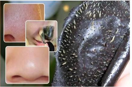 黑头克星来啦 如何去黑头