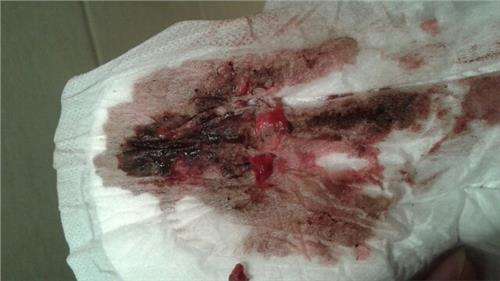 月经不调毛病多 月经量少发黑的原因