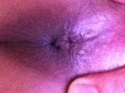 十男九痔之外痔疮