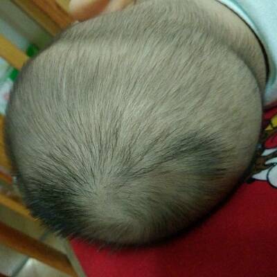 头发少怎么办  治疗脱发的偏方