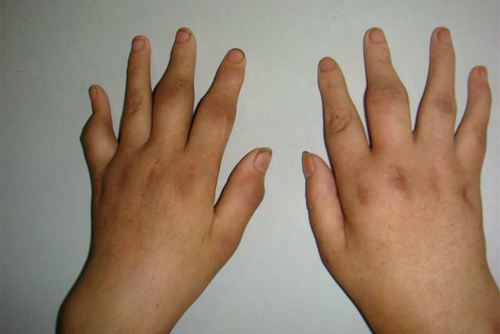 风湿和类风湿的区别你都知道吗