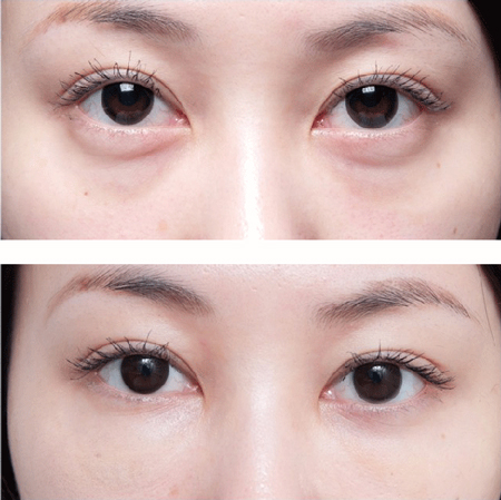 眼袋怎么去除，这三种方法很不错