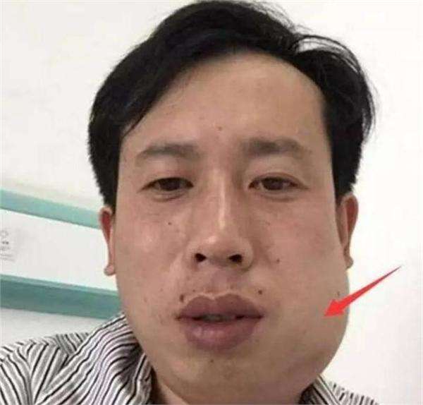 俊美的脸被打肿了怎么办你知道吗