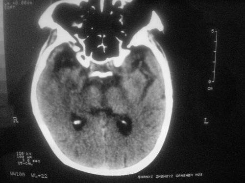 脑供血不足的症状会怎样损害我们的CPU
