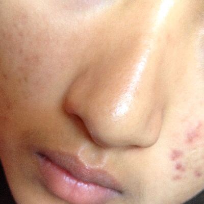 鼻子上有黑头怎么办  教你几招