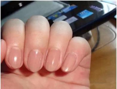亚健康的表现 手指甲上有小坑