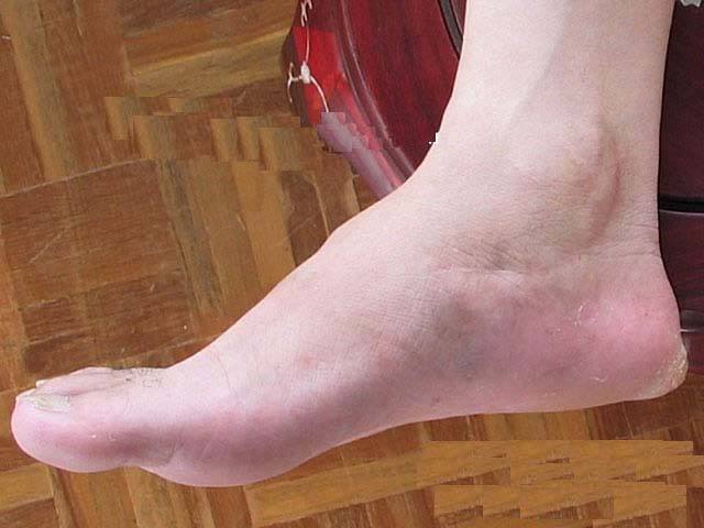 痛风的治疗方法 12个有效偏方推荐给你