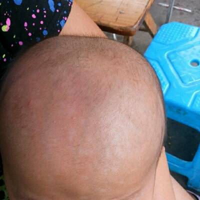 头癣的症状和局部治疗方法