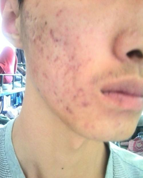 日常生活中脸上长痘痘该怎么办