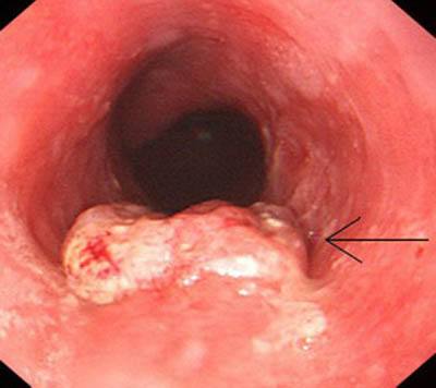 魔鬼病毒 食道癌的早期症状